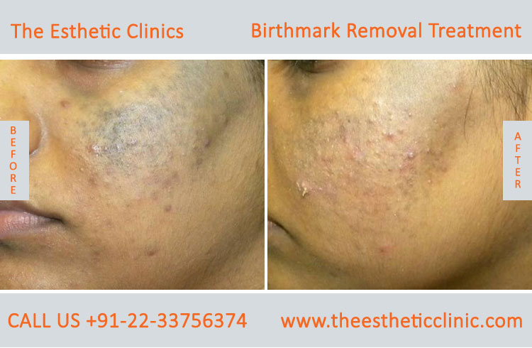 Birthmarks Removal Treatment before after photos in mumbai india (8)